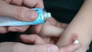 Mitos Berbahaya! Odol Tidak Boleh Digunakan Untuk Luka Bakar, Cek Fakta dan Resikonya