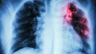 Mengenal Penyakit Lama yang Kembali ke Permukaan! Tuberkulosis