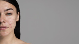 Mengapa Kulit Kusam Meski Sudah Pakai Skincare? Ini 5 Penyebabnya