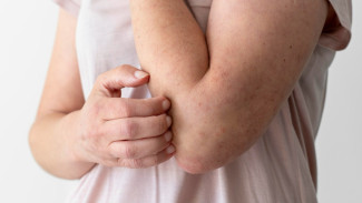 9 Cara Mengatasi Biduran Tanpa Obat yang Bisa Dicoba di Rumah