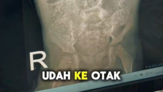 Dedi Mulyadi Kritik Kinerja Bidan Desa Setelah Balita 4 Tahun Meninggal Karena Cacingan