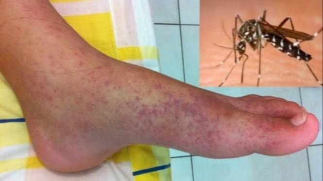 Contoh ruam kulit penderita Chikungunya