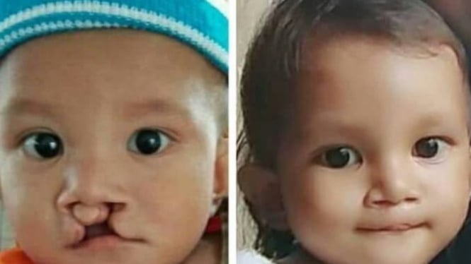 Ribuan Anak Bibir Sumbing Segera Dioperasi Gratis di Banyuwangi