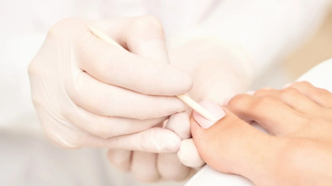 Cantengan, Masalah Kuku yang Sering Terjadi Tapi Diabaikan