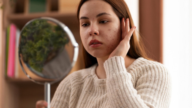 Ini Dia Skincare untuk Kulit Berjerawat dan Berminyak