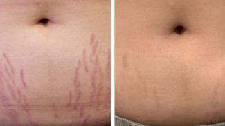 Tips Menghilangkan Stretch Mark dengan Bahan Alami Murah Aman dan Mudah Dipakai