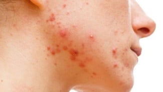 5 Bahan Dapur Ampuh Usir Jerawat Membandel, Dokter Sudah Buktikan Khasiatnya yang Manjur