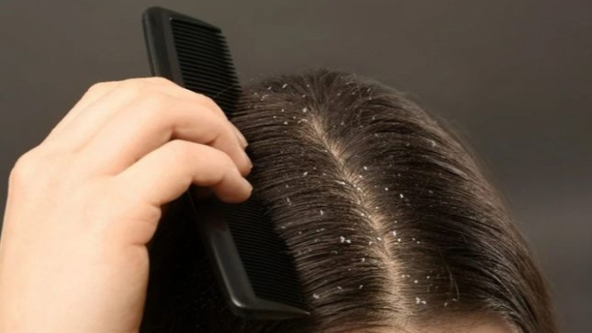 Tips Mengatasi Ketombe Rambut dengan Baking Soda