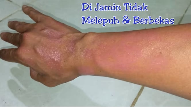 tangan terkena air panas