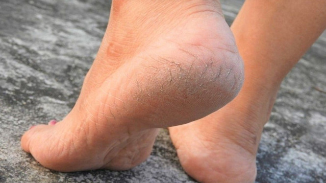 Cara Mengatasi Kulit Kaki Pecah