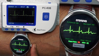 Smartwatch ECG: Sekadar Gaya atau Penyelamat Jantung Anda? Ini Faktanya!