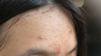 Cara Alami Menghilangkan Bruntusan di Dahi dengan Bahan Rumahan Mudah