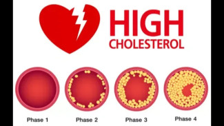 Ini Dia Gejala Kolesterol Tinggi yang Sering Diabaikan, Jangan Sampai Terlambat!