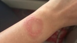 Apple Watch Overheat Hingga Picu Luka Bakar Permanen