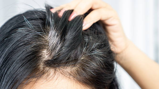 Cara Mengatasi Uban di Usia Muda