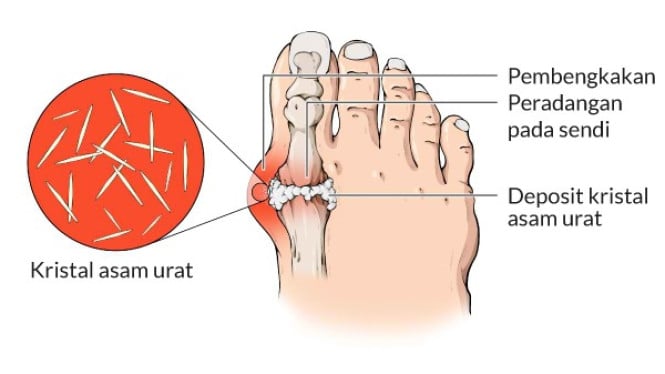 Gejala Awal Asam Urat yang Sering Diabaikan, Apa Saja? Temukan Jawabannya di Sini!