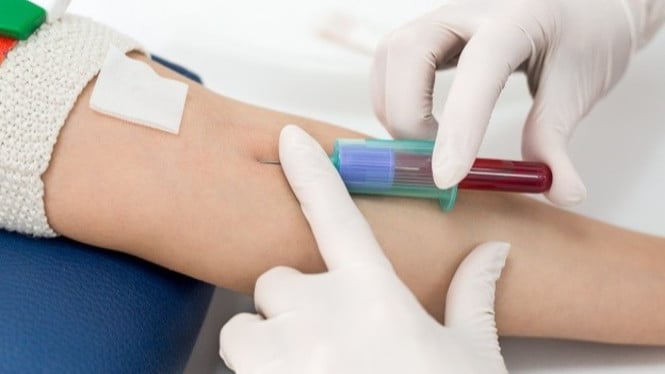 Cukup Tes Darah, Alzheimer Bisa Terdeteksi Sejak Dini! Norwegia Jadi yang Pertama