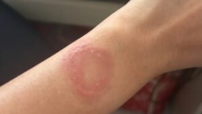 Apple Watch Overheat Hingga Picu Luka Bakar Permanen