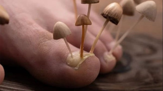 Kuku Kaki Berjamur? Jangan Panik, Cukup Bawang dan Cuka!