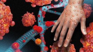 Dinkes Sebut Suspek Cacar Monyet di Brebes Masih Dugaan: Belum Positif Mpox