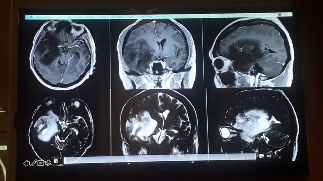 Visualisasi hasil scan pasien tumor otak