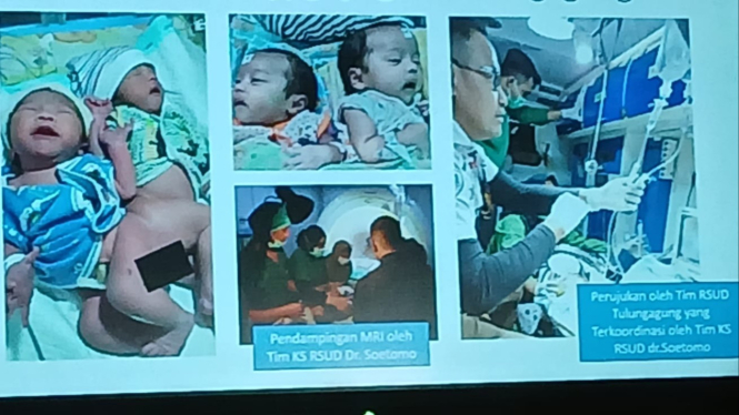 Operasi pemisahan bayi kembar siam di RSUD dr Soetomo Surabaya.