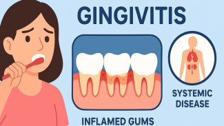 Gingivitis, Masalah Sepele yang Bisa Berujung Penyakit Berat