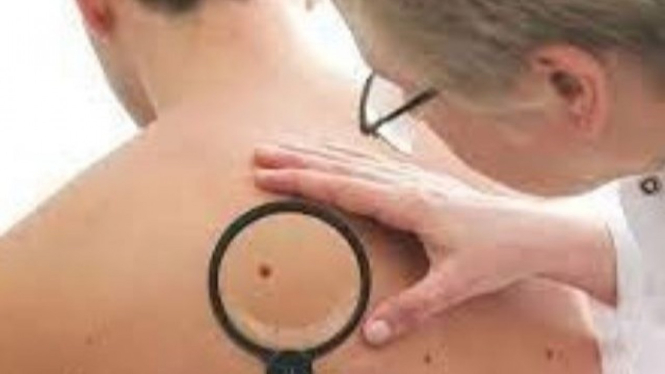 Dokter memeriksa pria yang alami melanoma
