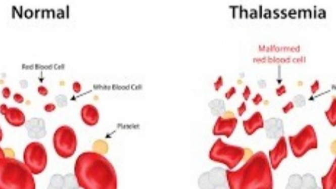 Ilustrasi thalassemia