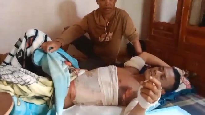 Purwanto Korban Terbakar Api