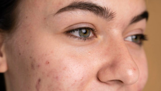 Retinol vs Niacinamide, Mana yang Paling Ampuh Atasi Jerawat?