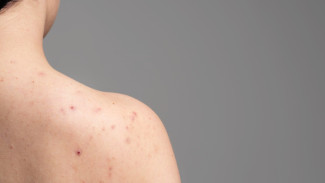 Jerawat di Punggung Bikin Nggak Percaya Diri? Ini Tips Skincare & Gaya Hidup yang Bisa Bantu