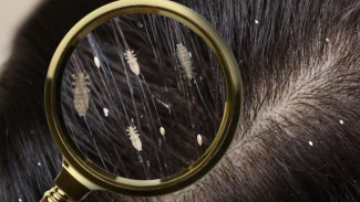 7 Cara Ampuh Mengatasi Kutu Rambut Hilang Sampai Telur-Telurnya