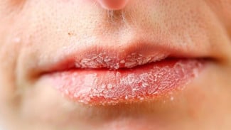 Bibir Kering dan Mengelupas saat Jalani Puasa Ramadhan, Begini Cara Mengatasinya