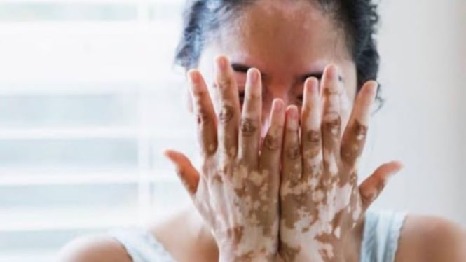 Vitiligo