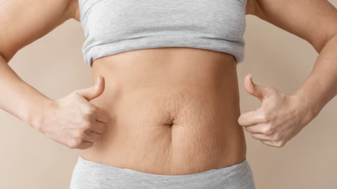 Ilustrasi Stretch Mark