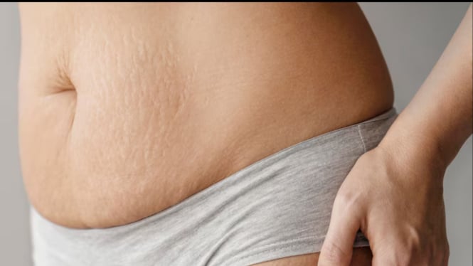 Ilustrasi Stretch Mark