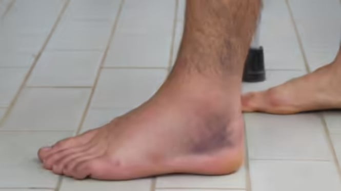 Tanda diabetes di kaki
