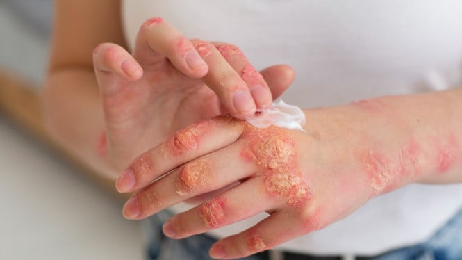 gatal psoriasis