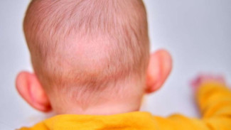 Dolichocephaly pada Bayi, 5 Langkah Praktis Mengatasi Bentuk Kepala Memanjang