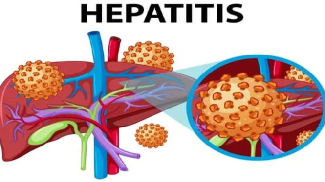 Ilustrasi organ hati yang terserang virus hepatitis