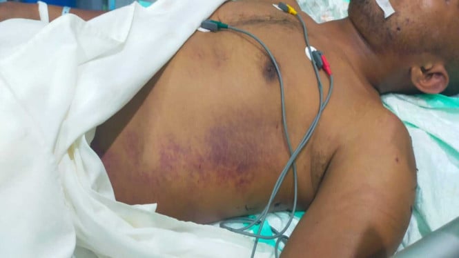 Lebam-lebam pada tubuh Prada Lucky Chepril Saputra Namo