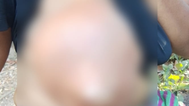 Di Tengah Duka Gempa Manggarai Timur, Emirensiana Berjuang Melawan Kanker Payudara