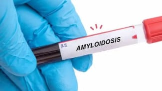 Segala Hal tentang Amiloidosis yang Perlu Anda Tahu