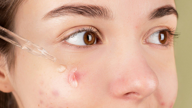 Potret wanita mengaplikasikan cleansing oil ke wajah yang berjerawat