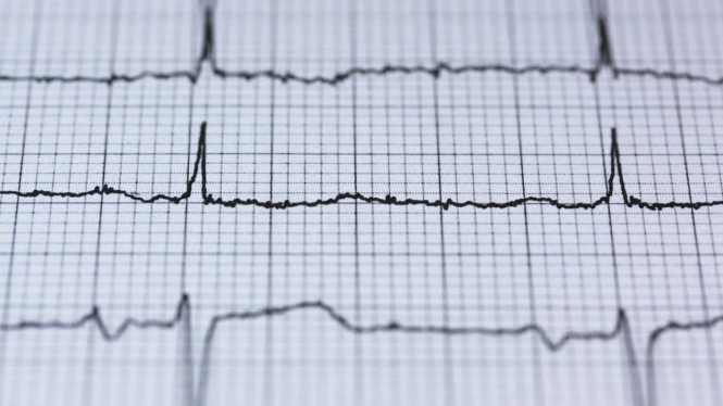 EKG Jantung