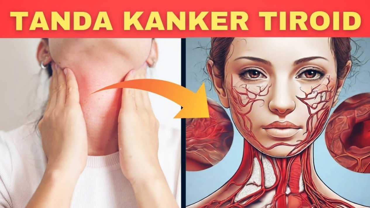 10 Tanda Kanker Tiroid Paling Berbahaya, Jangan Sampai Telat Deteksi
