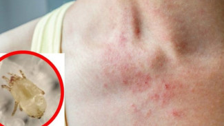 Jangan Anggap Remeh! Tungau Kasur Bisa Sebabkan 3 Masalah Kulit Ini