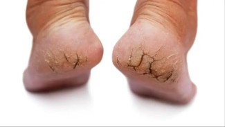 Tips Menghilangkan Pecah-pecah di Tumit, Mudah, Murah, dan Ampuh!