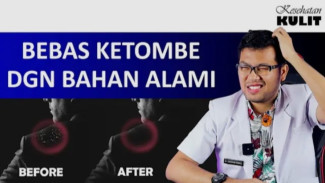 Stop Bikin Malu! Ini 5 Rahasia Menghilangkan Ketombe Bandel dengan Cepat!